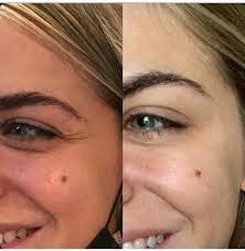 botox injections in dubai