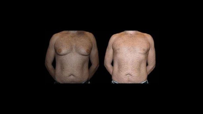 Before and After Male Breast Reduction Surgery