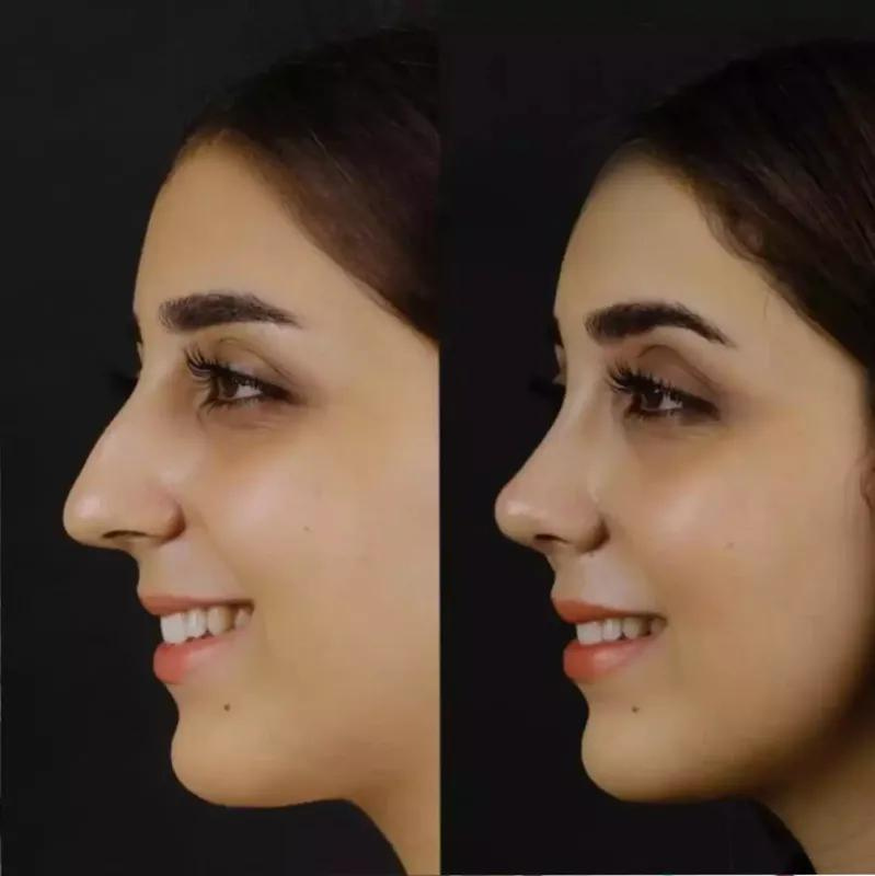 Who is a Candidate for Septoplasty in Dubai?