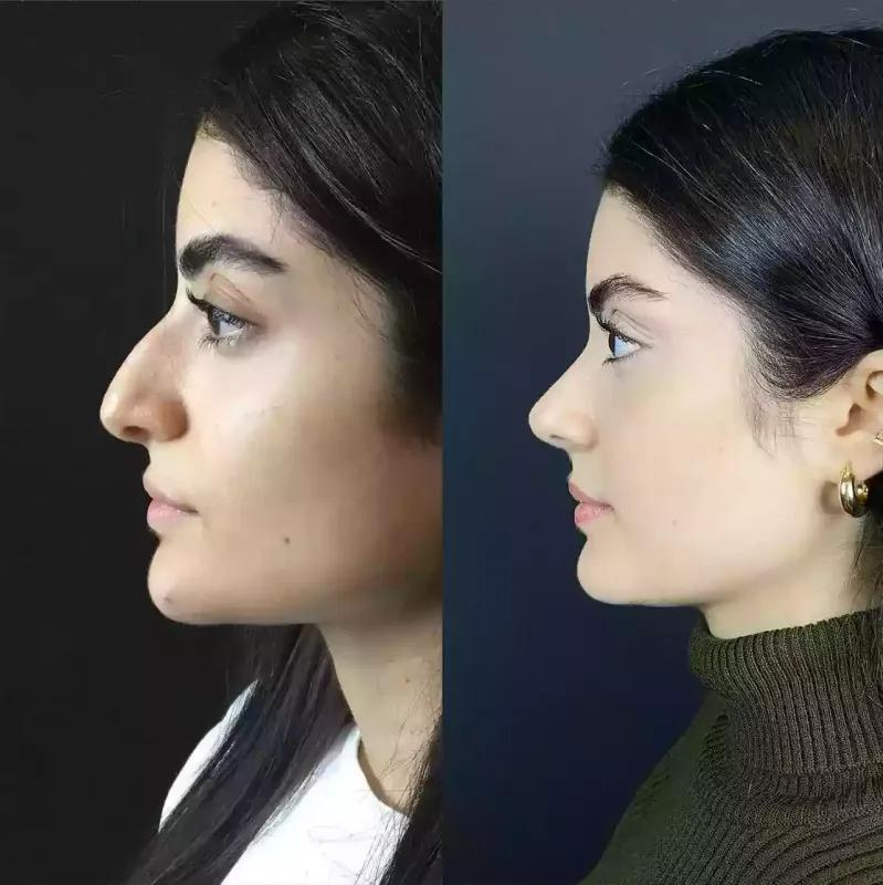 rhinoplasty in dubai